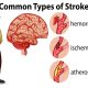 انواع سکته مغزی